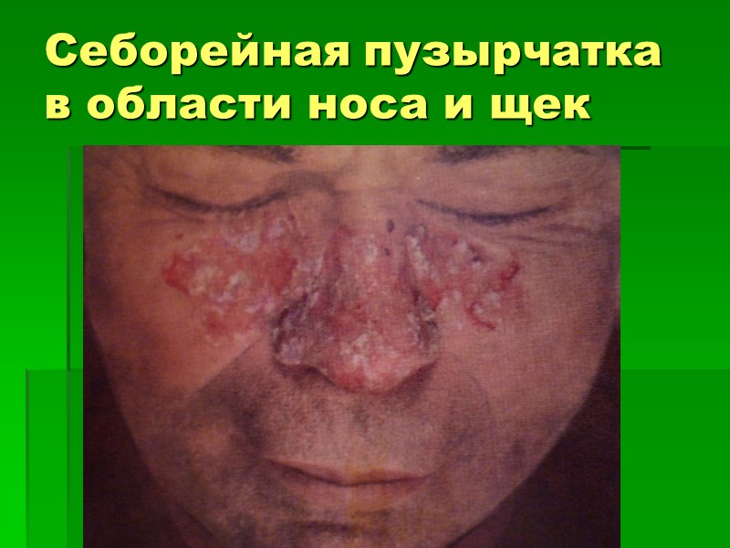 Себорейная пузырчатка в области носа и щек